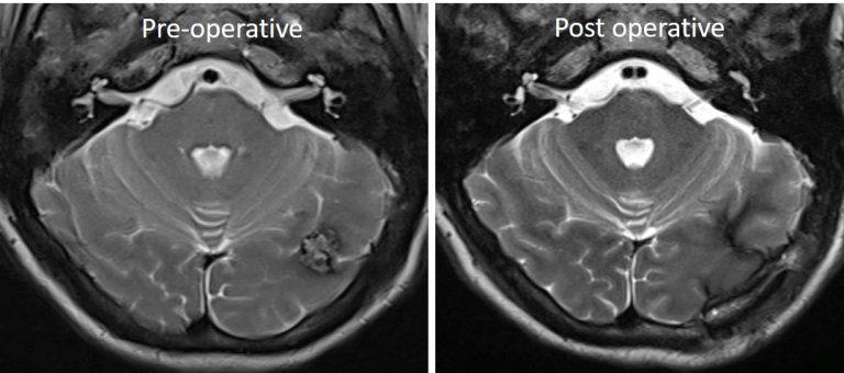 Cavernous Angioma – Radiology Cases