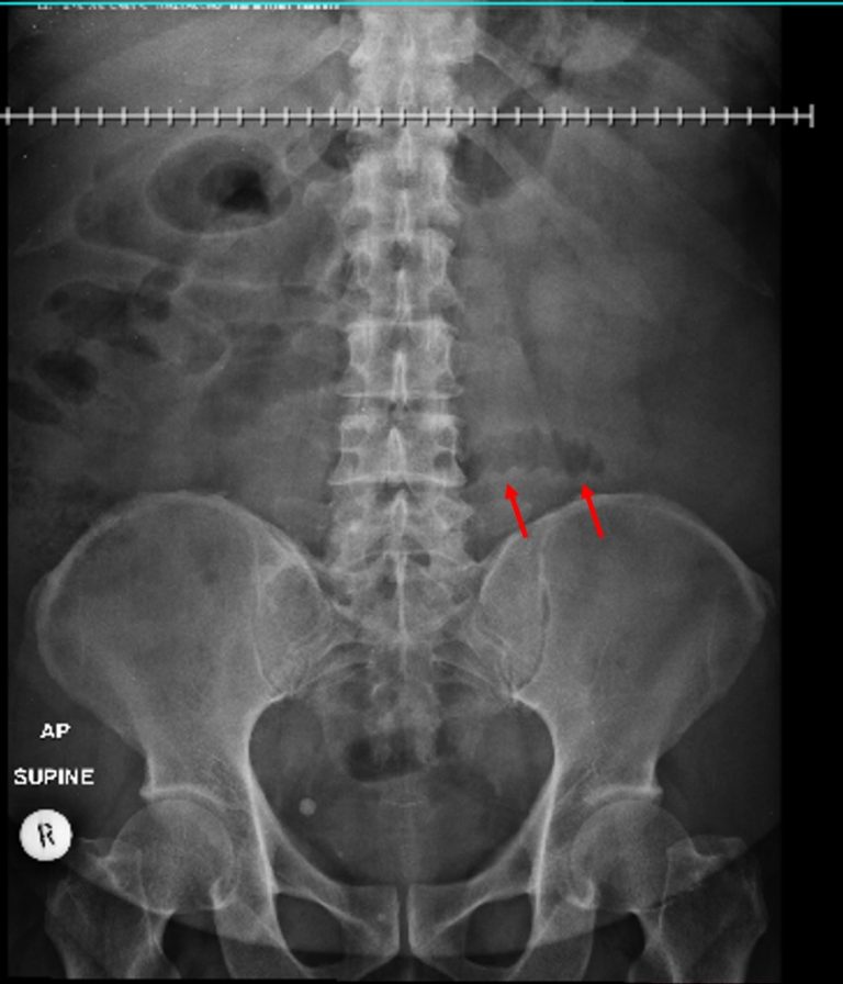 Acute Diverticulitis Radiology Cases