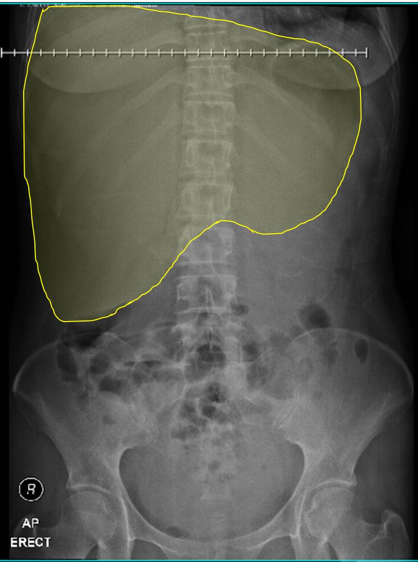 Elevated hemidiaphragm Radiology Cases