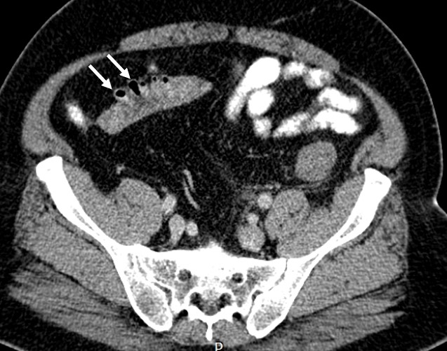 Acute Diverticulitis Radiology Cases