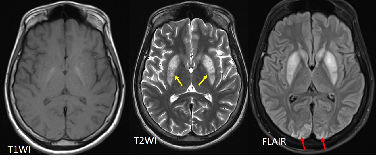 global-hypoxic-ischaemic-injury-radiology-cases