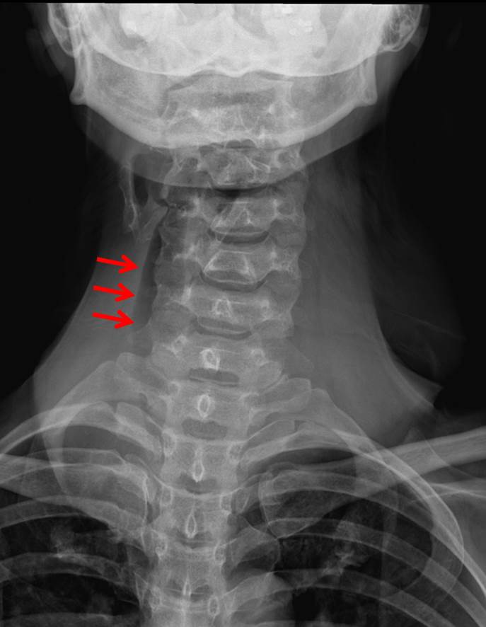 Anaplastic Thyroid Carcinoma – Radiology Cases