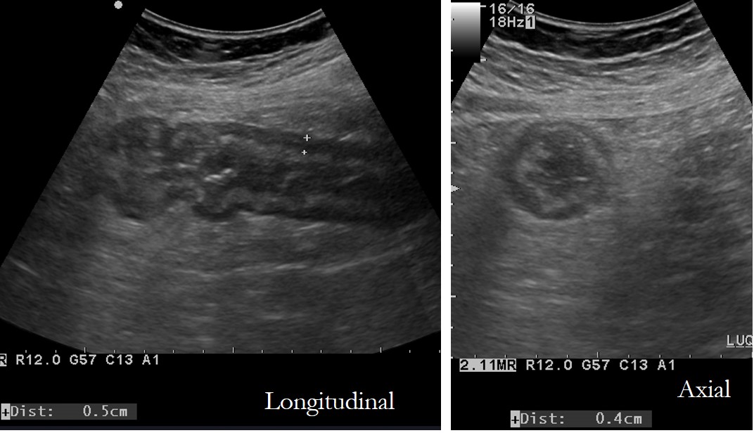 Acute Diverticulitis Radiology Cases 9641