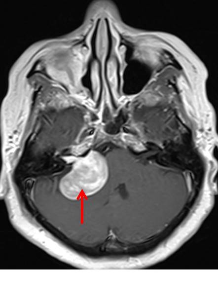 Vestibular Schwannoma Radiology Cases Vestibular Schwannoma Radiology Cases