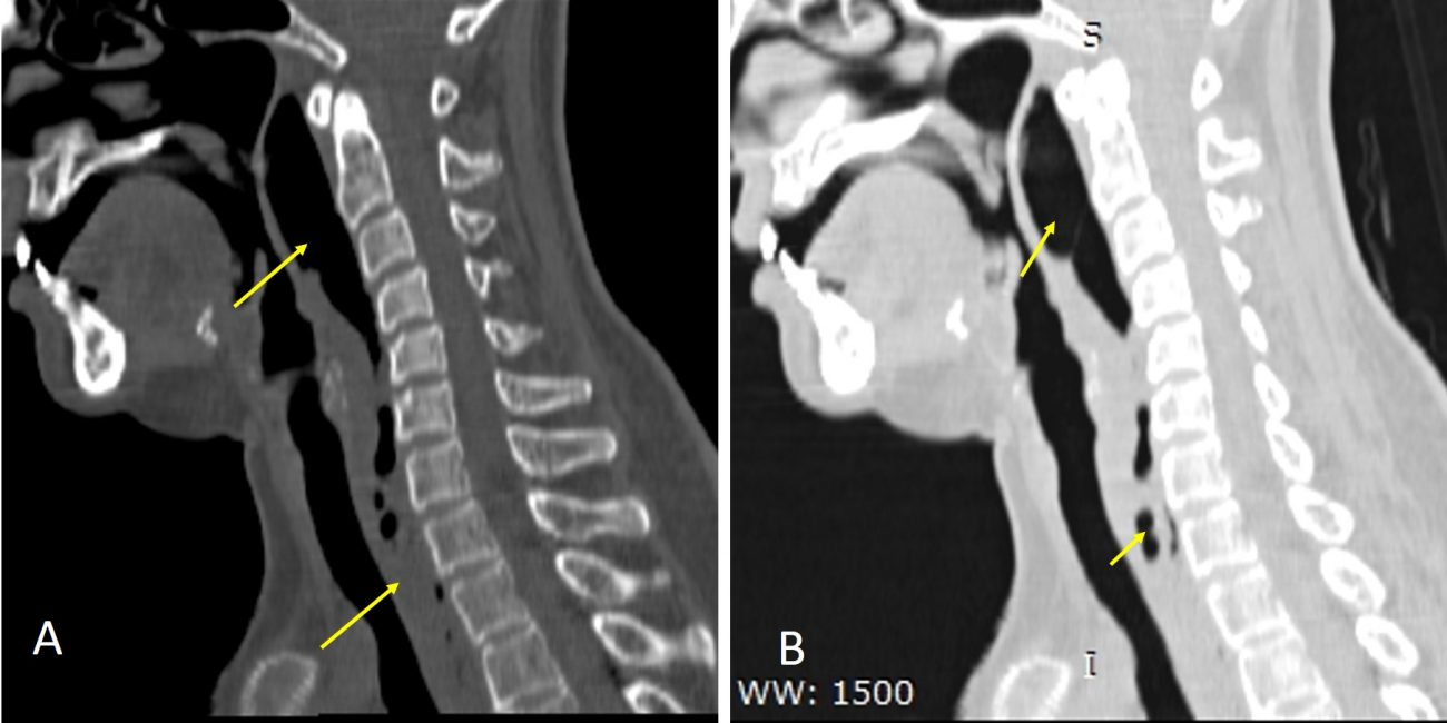 Retropharyngeal abscess Radiology Cases