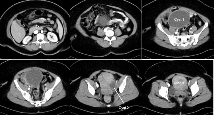 Ruptured ovarian cyst, Radiology Reference Article