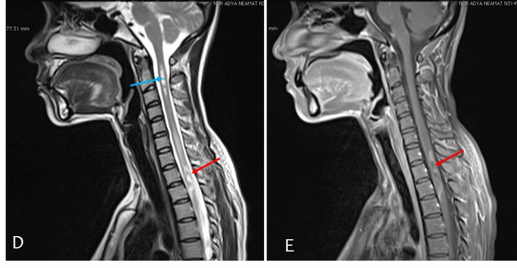 Neuromyelitis optica Radiology Cases