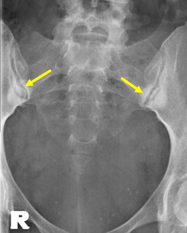 Osteitis Condensans Ilii Radiology Cases