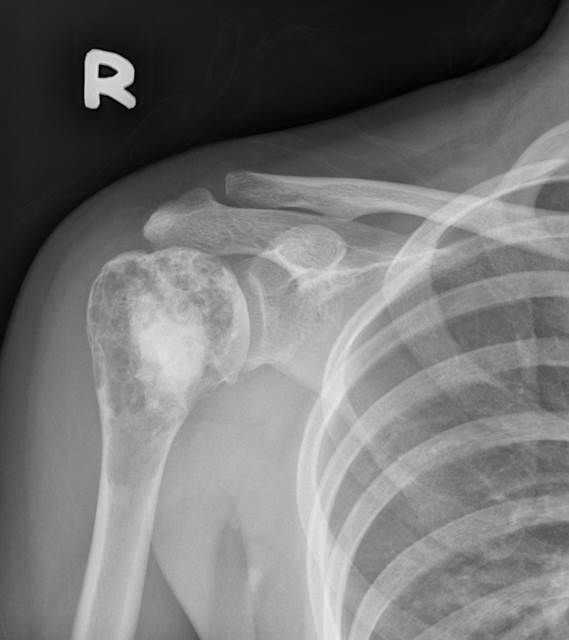 enchondroma-of-humerus-radiology-cases