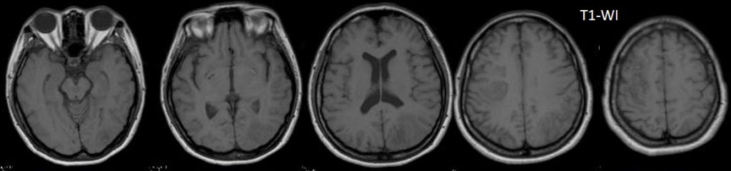 Subacute Infarction With Gyriform Enhancement Radiology Cases