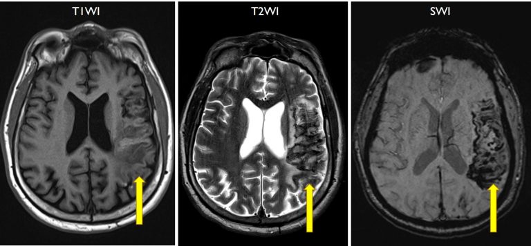 Wallerian Degeneration Radiology Cases