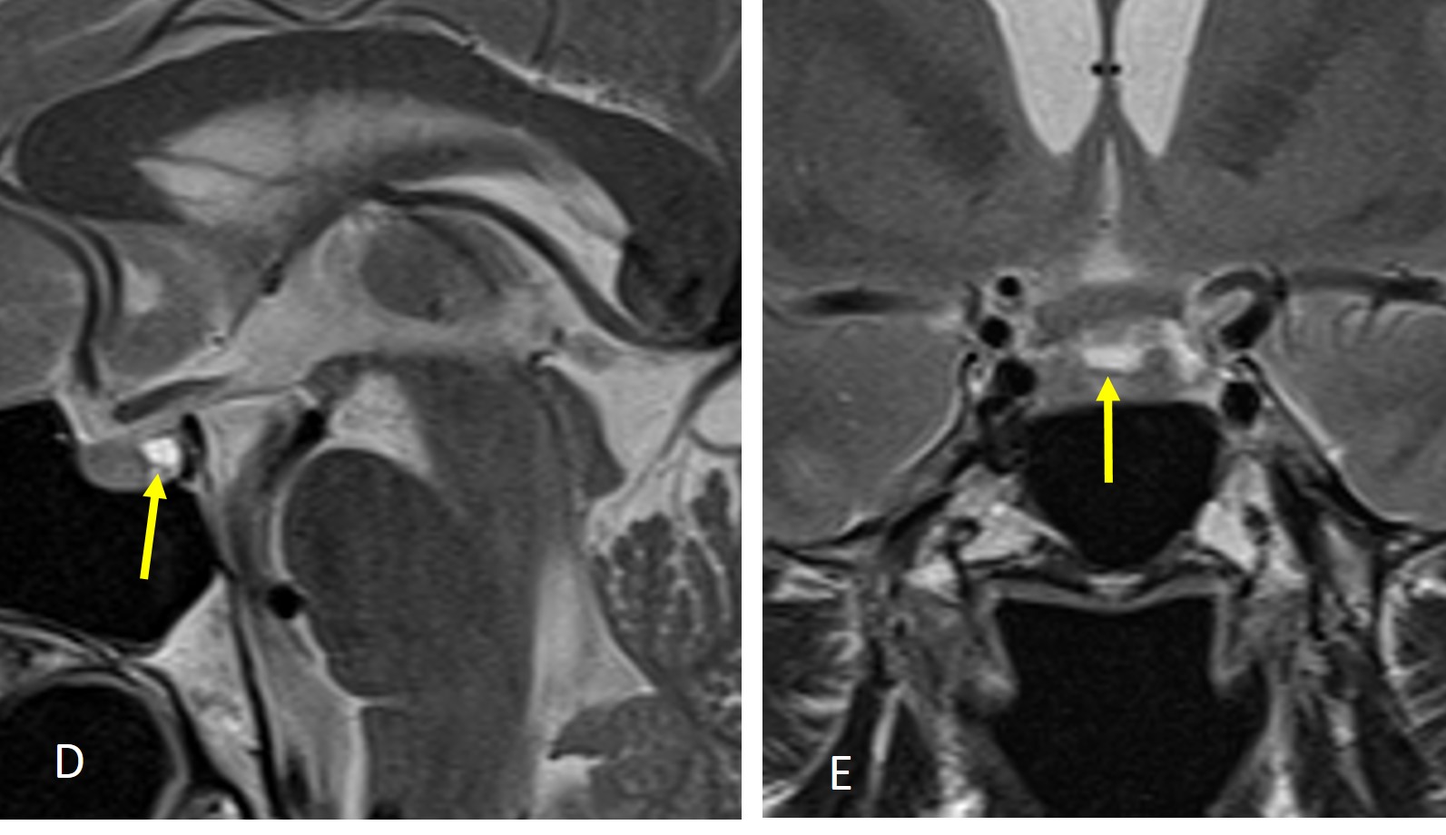 Rathke Cleft Cyst Radiology Cases