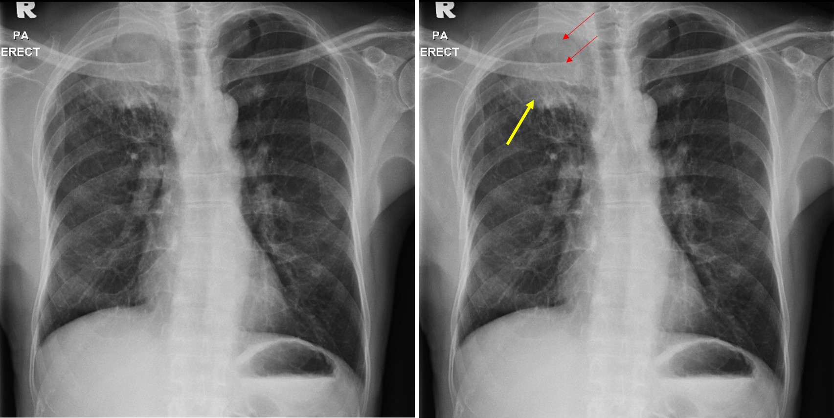 Lung Cancer Adenocarcinoma Radiology Cases