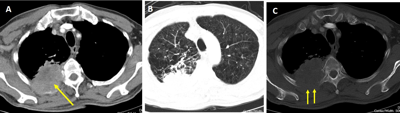 Lung Cancer Adenocarcinoma Radiology Cases
