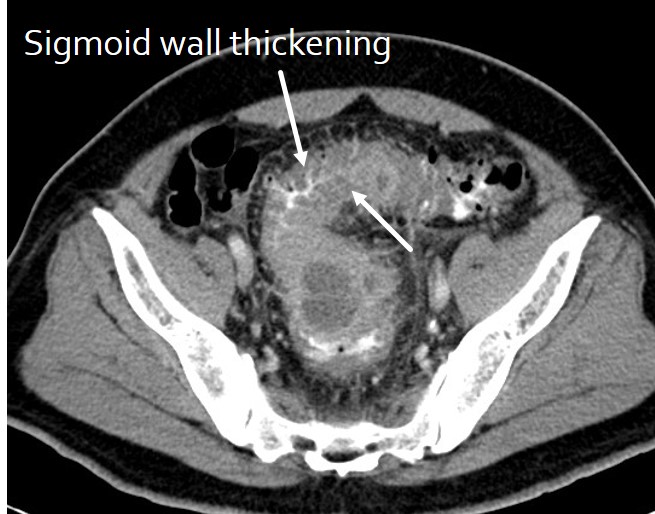 Complicated Diverticulitis Radiology Cases 8898