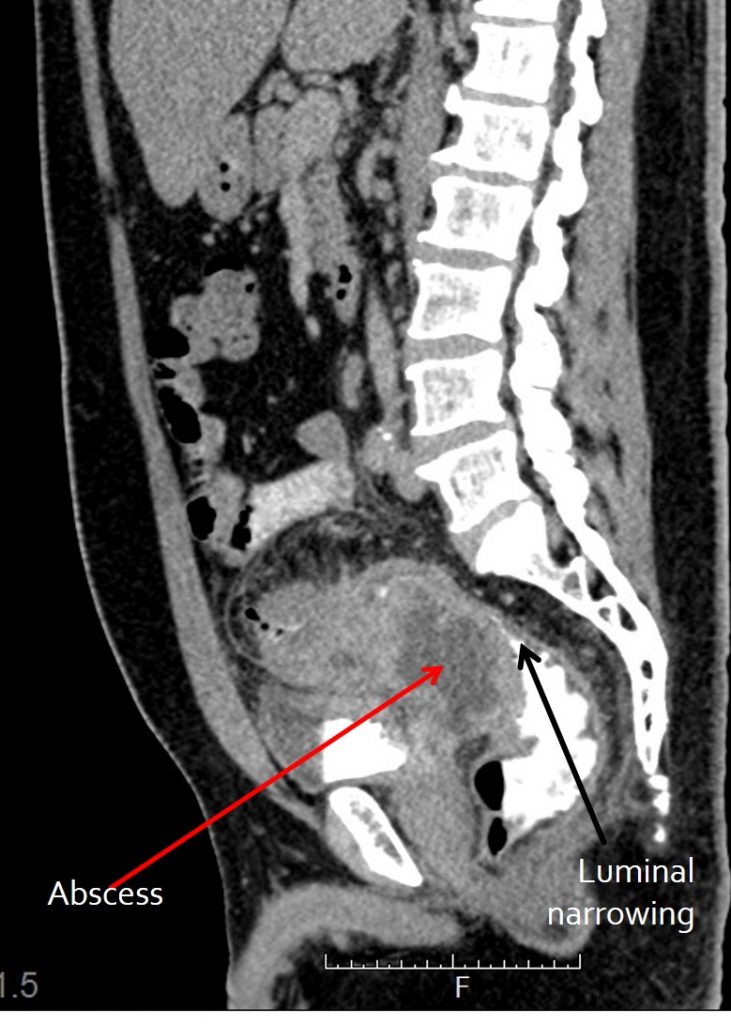 diverticulitis ct images