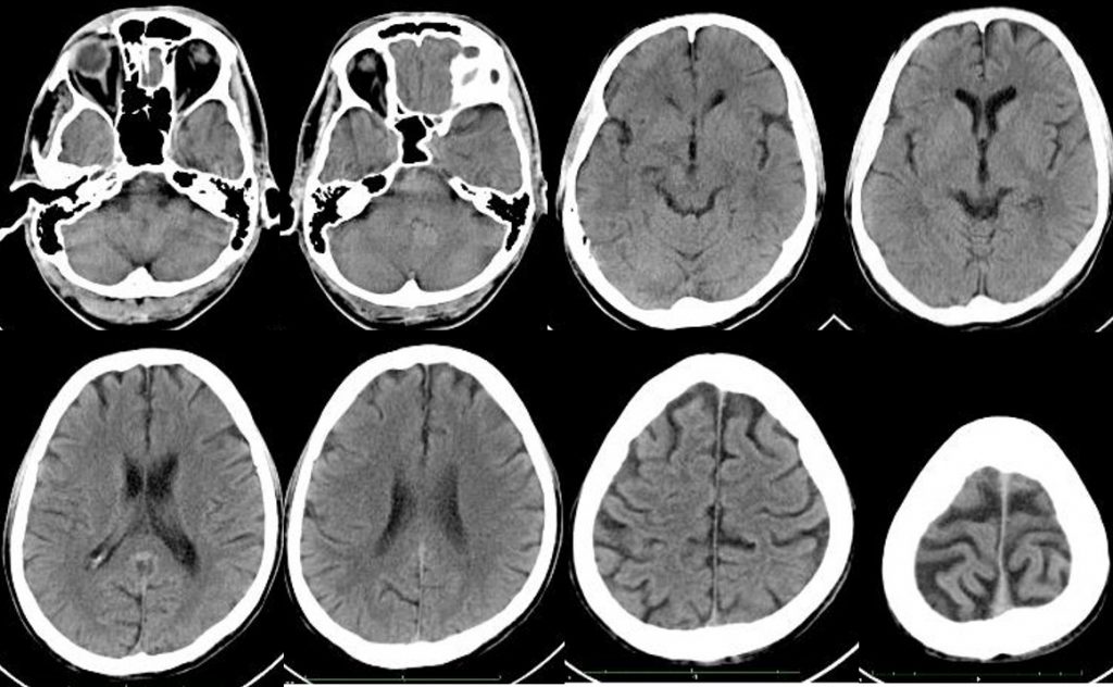 PICA infarct, Radiology Case