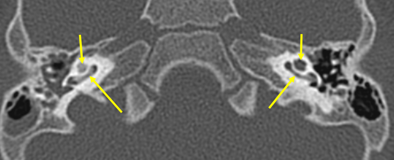 Labyrinthitis ossificans Radiology Cases