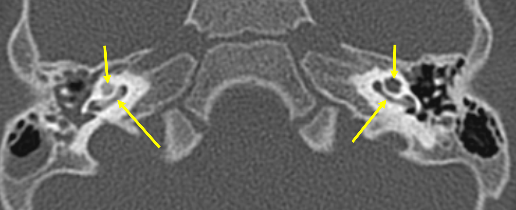 labyrinthitis-ossificans-radiology-cases