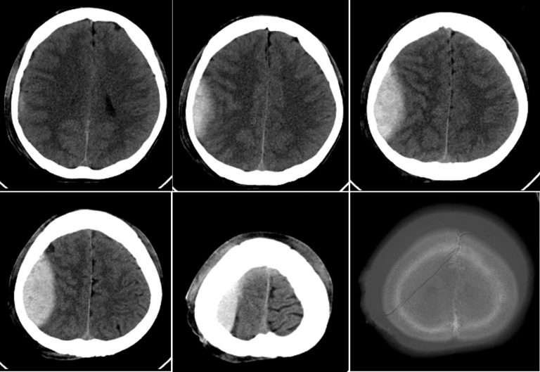 Extradural Haemorrhage – Radiology Cases