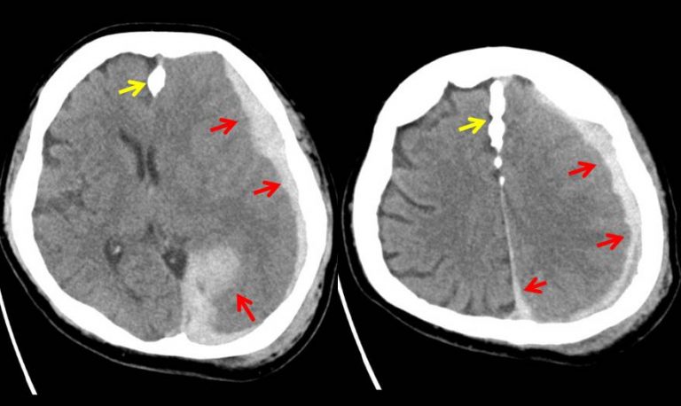 Acute Subdural Haemorrhage Radiology Cases