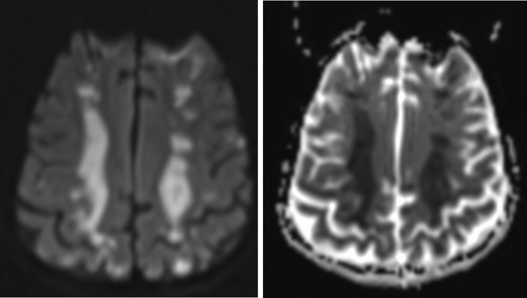 watershed-infarction-radiology-cases