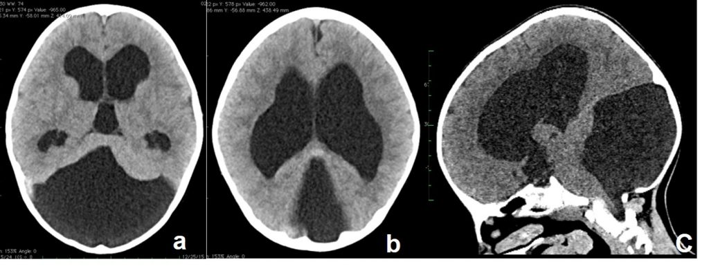 dandy walker syndrome