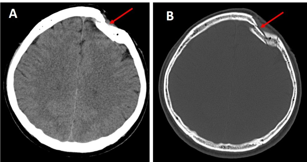 depressed-skull-fracture-radiology-cases