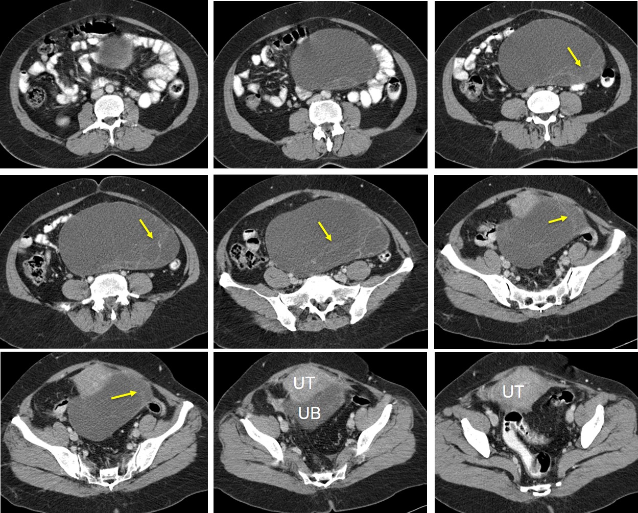 Ovarian Mucinous Cystadenoma – Radiology Cases