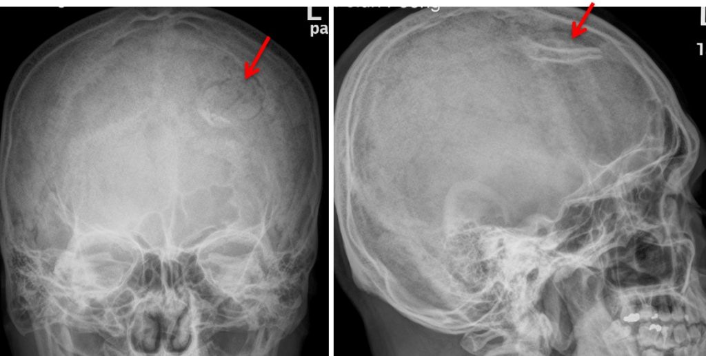 Depressed skull fracture Radiology Cases