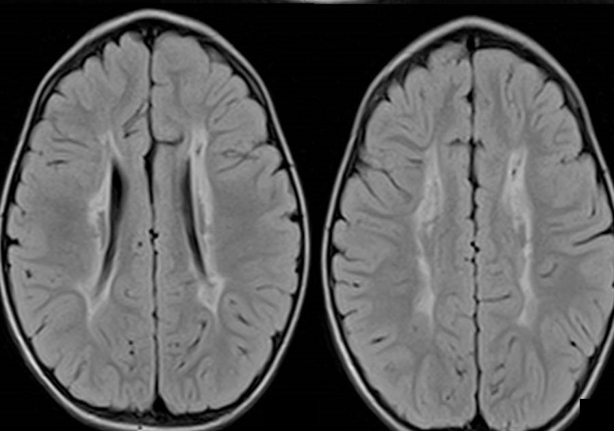 Radiology Cases Page 44 Compilation Of Cases Emphasize On Imaging 