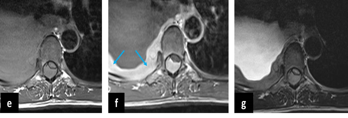 Spinal Lymphoma – Radiology Cases