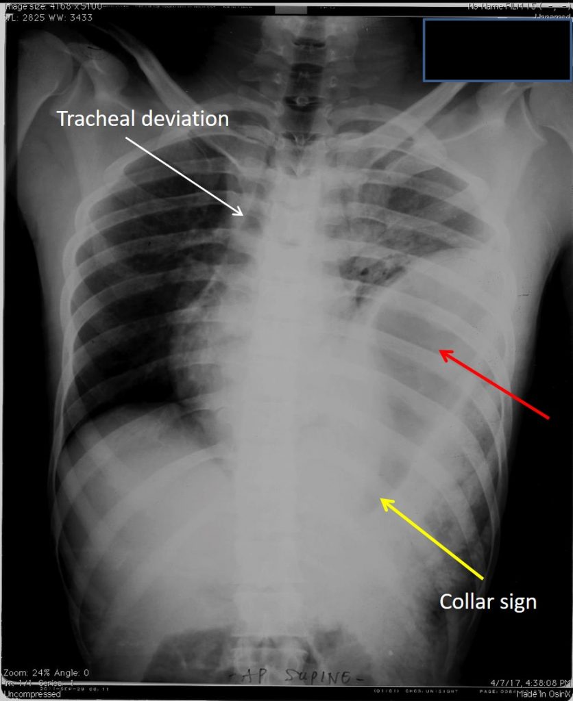 Traumatic Diaphragmatic Hernia Radiology Cases