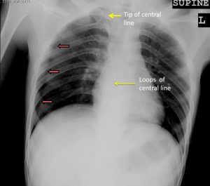 Iatrogenic Pneumothorax – Radiology Cases