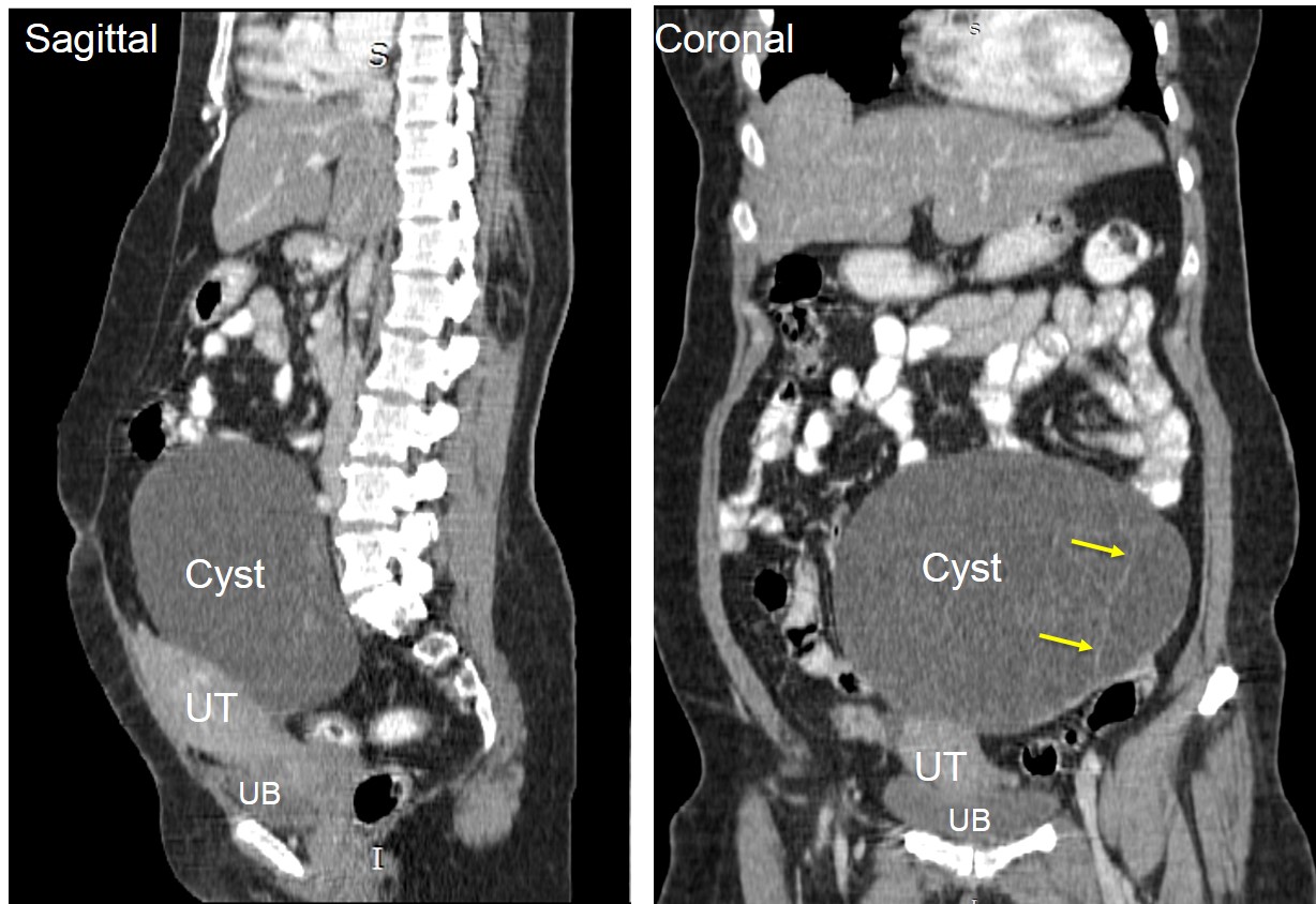 Ovarian Mucinous Cystadenoma Radiology Cases