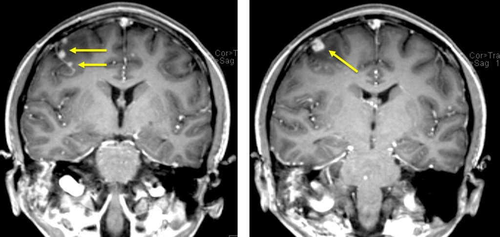 Cns Tuberculosis – Radiology Cases