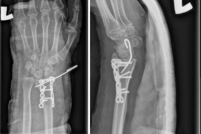 Barton fracture Radiology Cases