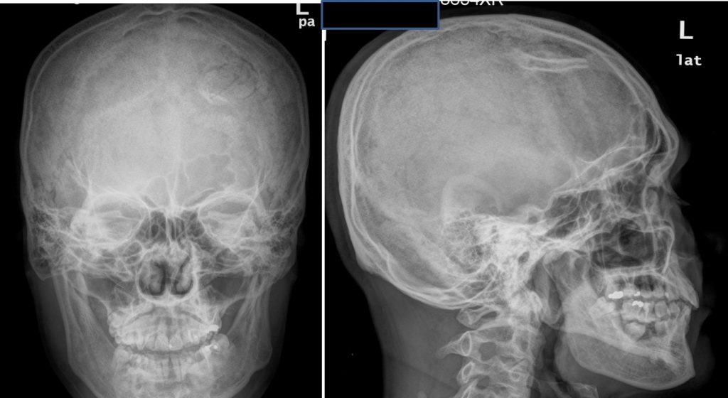 fractured skull x ray