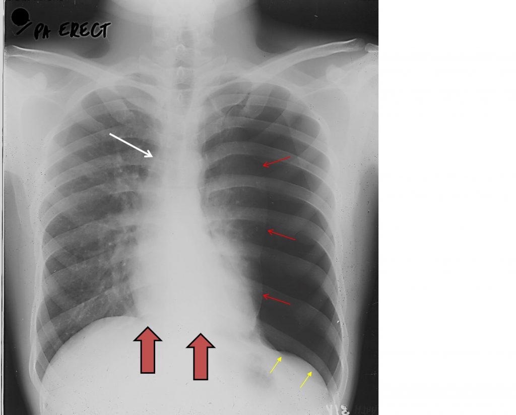 Tension pneumothorax Radiology Cases