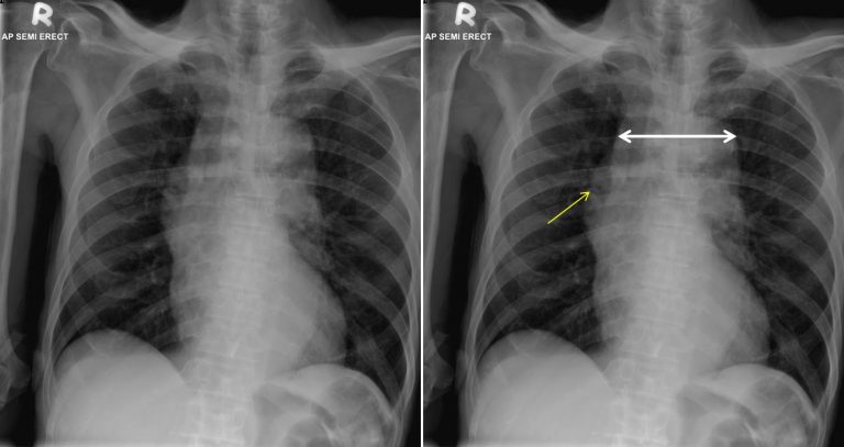 Unfolded Aorta Radiology Cases