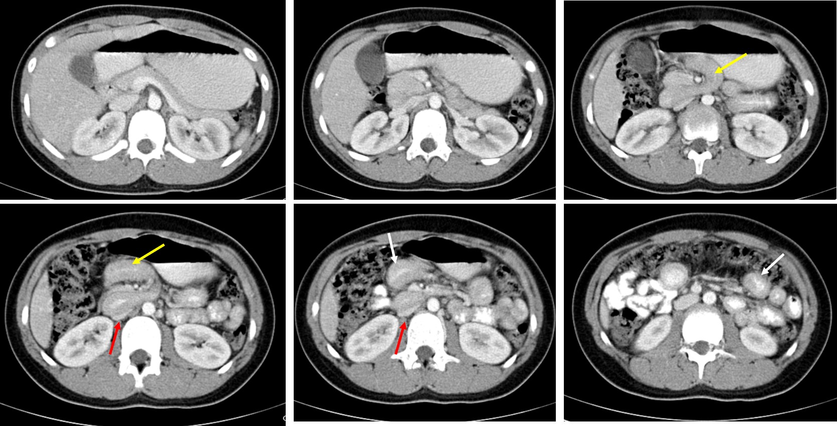 Midgut Volvulus Radiology Cases