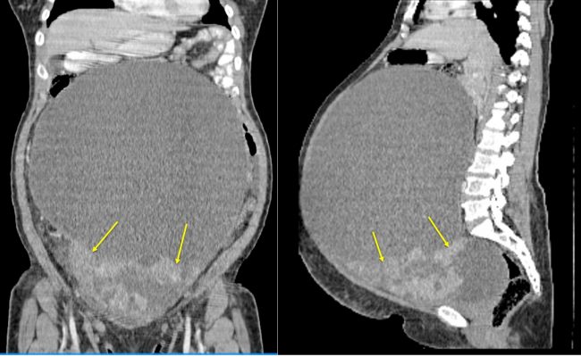 Ovarian Mucinous Cystadenoma Of Borderline Malignancy Radiology Cases