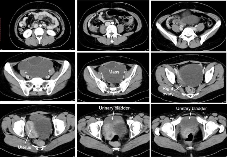 Ovarian Mucinous Cystadenoma 2 Radiology Cases