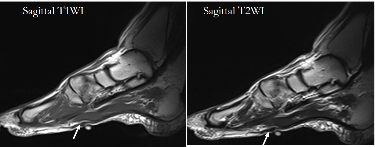 Plantar Fibromatosis Radiology Cases