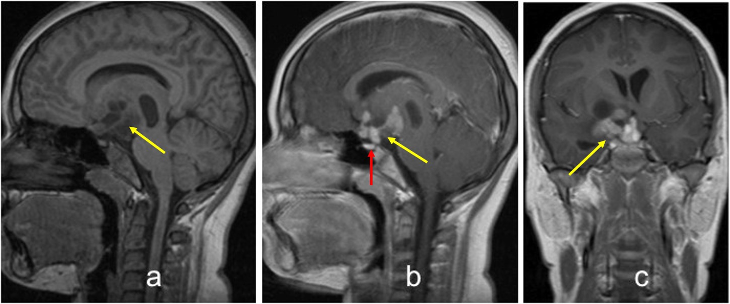 suprasellar-germinoma-radiology-cases