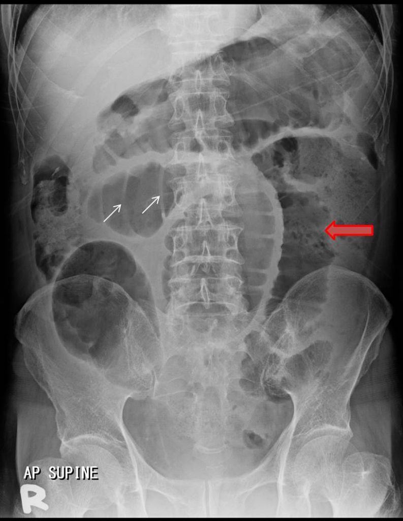 small-bowel-obstruction-radiology-cases