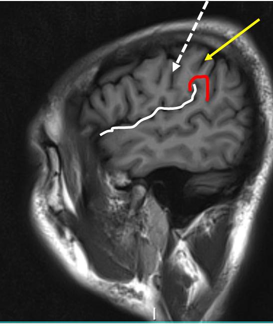 central-sulcus-radiology-cases