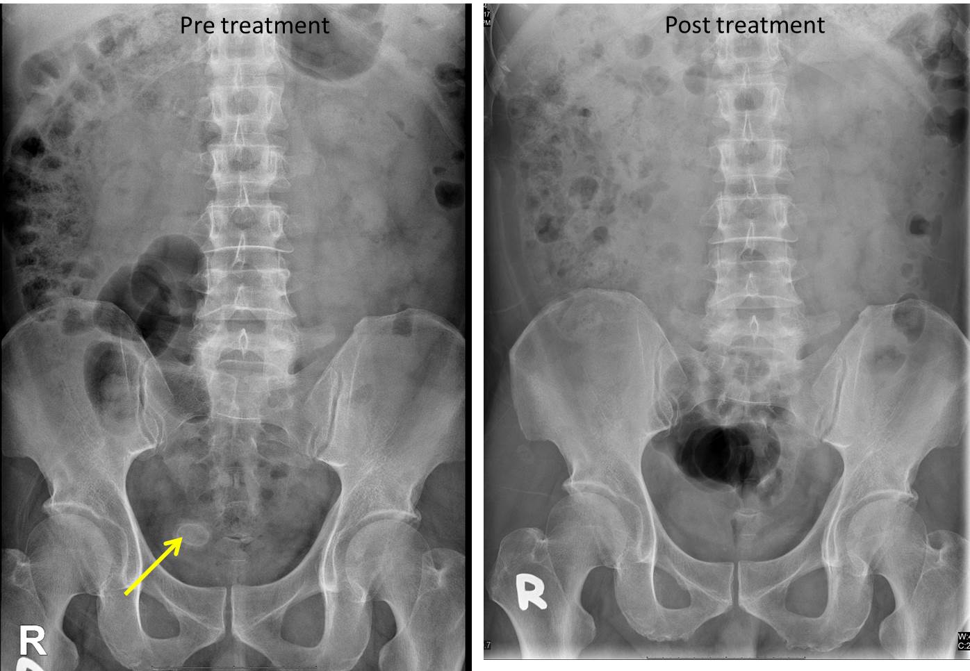 Primary Urinary Bladder Calculus – Radiology Cases