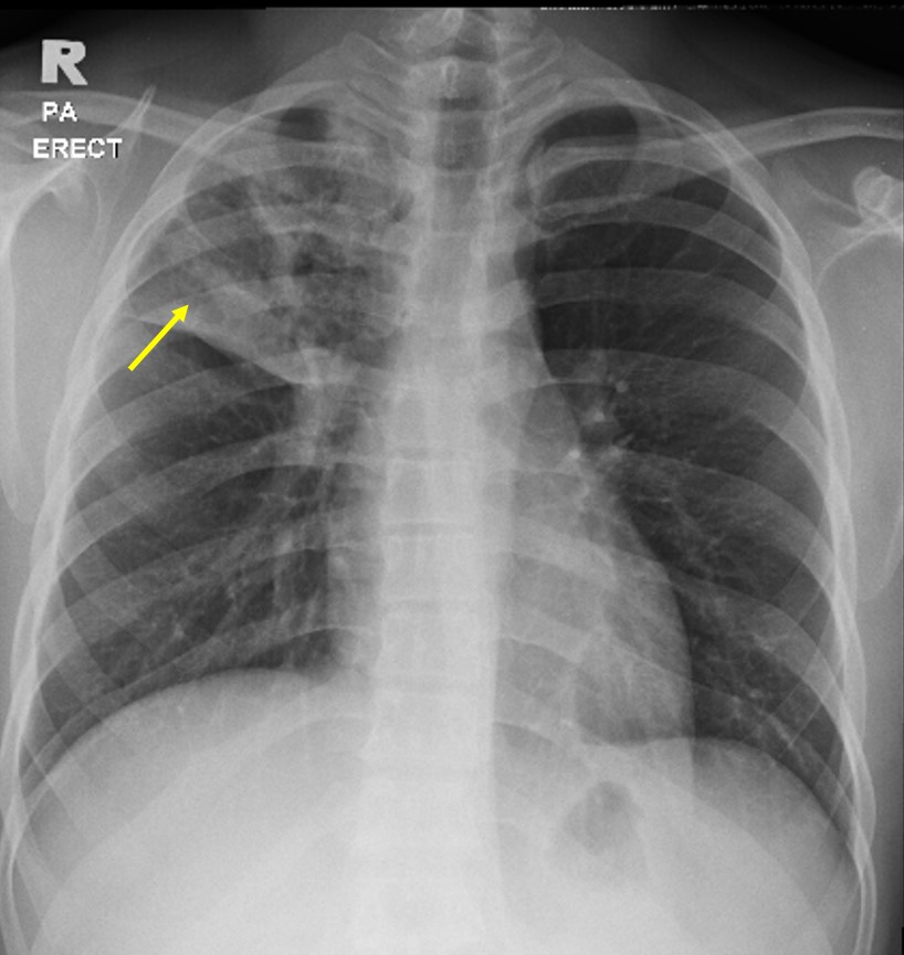 Pulmonary Tuberculosis – Radiology Cases