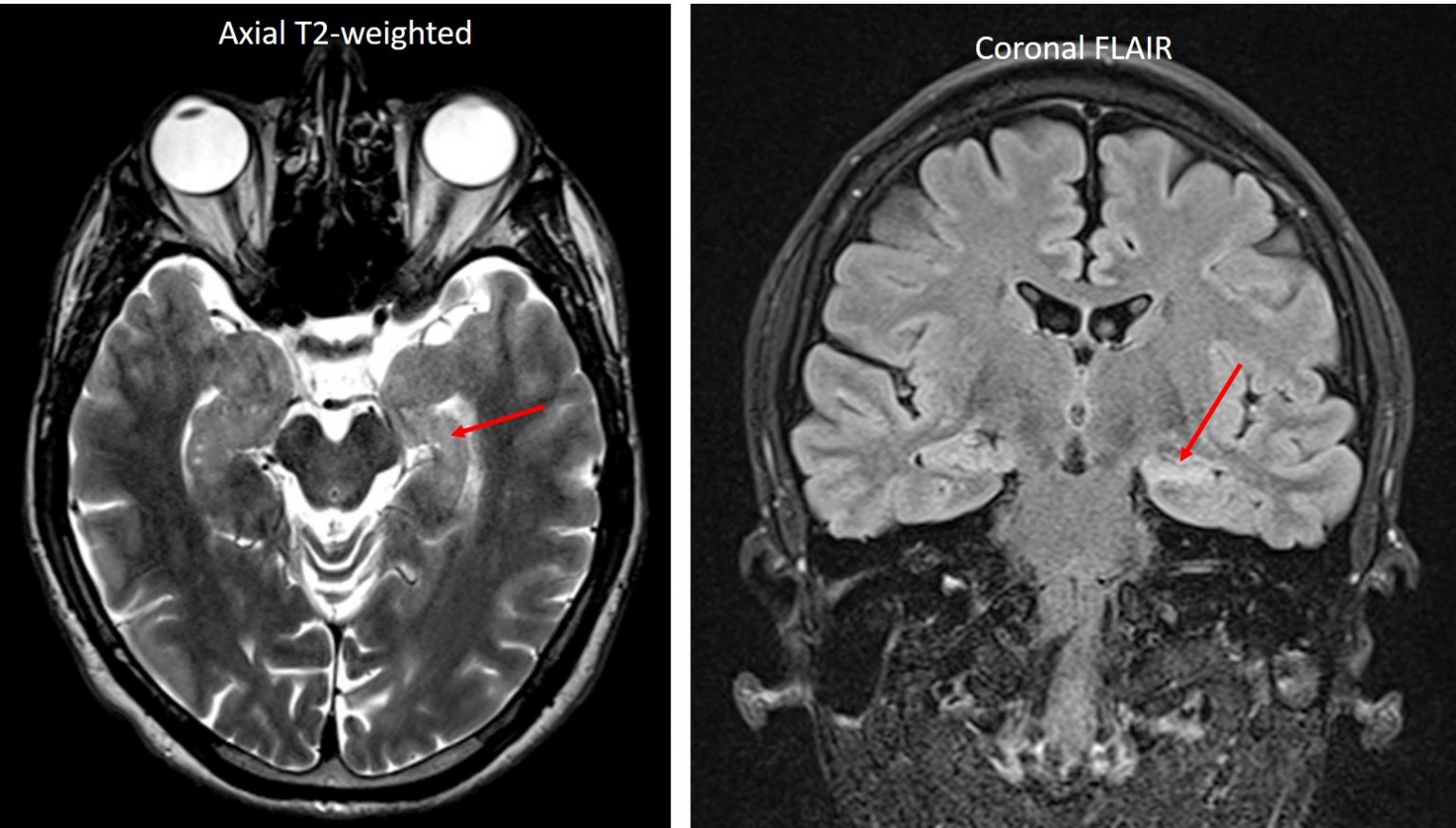 mesial-temporal-sclerosis-radiology-cases